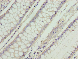 RD3 Antibody - Immunohistochemistry of paraffin-embedded human colon cancer using RD3 Antibody at dilution of 1:100