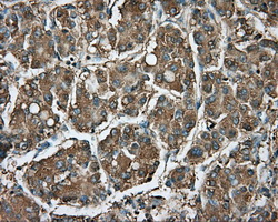 RDH11 Antibody - IHC of paraffin-embedded Carcinoma of liver tissue using anti-RDH11 mouse monoclonal antibody. (Dilution 1:50).