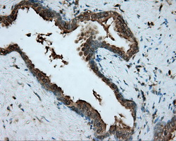 RDH11 Antibody - IHC of paraffin-embedded Carcinoma of prostate tissue using anti-RDH11 mouse monoclonal antibody. (Dilution 1:50).