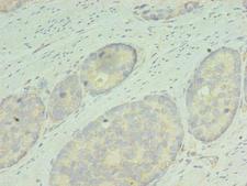 RDH12 / LCA3 Antibody - Immunohistochemistry of paraffin-embedded human gastric cancer using RDH12 Antibody at dilution of 1:100