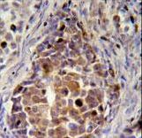 RDH16 Antibody - RDH16 Antibody (N-term immunohistochemistry of formalin-fixed and paraffin-embedded human skin carcinoma followed by peroxidase-conjugated secondary antibody and DAB staining.