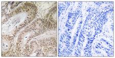 RDM1 Antibody - Immunohistochemistry analysis of paraffin-embedded human colon carcinoma, using RDM1 Antibody. The picture on the right is blocked with the synthesized peptide.