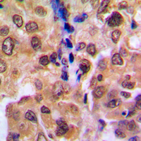 RDM1 Antibody - Immunohistochemical analysis of RAD52B staining in human breast cancer formalin fixed paraffin embedded tissue section. The section was pre-treated using heat mediated antigen retrieval with sodium citrate buffer (pH 6.0). The section was then incubated with the antibody at room temperature and detected using an HRP-conjugated compact polymer system. DAB was used as the chromogen. The section was then counterstained with hematoxylin and mounted with DPX.