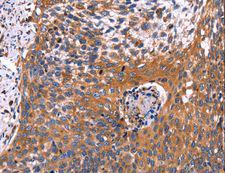 RDX / Radixin Antibody - Immunohistochemistry of paraffin-embedded Human cervical cancer using RDX Polyclonal Antibody at dilution of 1:60.