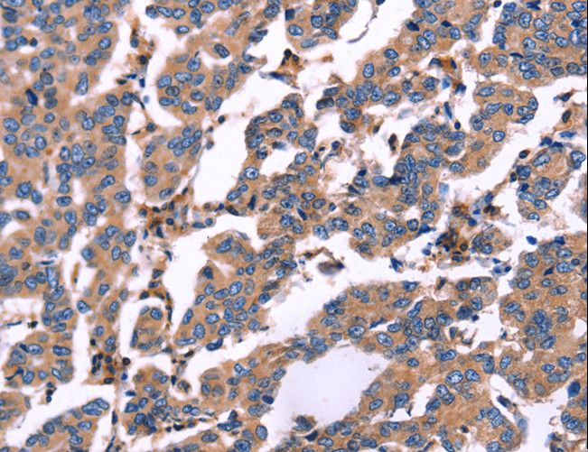 RDX / Radixin Antibody - Immunohistochemistry of paraffin-embedded Human breast cancer using RDX Polyclonal Antibody at dilution of 1:60.