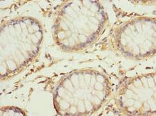 REC8 Antibody - Immunohistochemistry of paraffin-embedded human colon cancer at dilution 1:100
