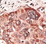 Recoverin Antibody - Formalin-fixed and paraffin-embedded human cancer tissue reacted with the primary antibody, which was peroxidase-conjugated to the secondary antibody, followed by DAB staining. This data demonstrates the use of this antibody for immunohistochemistry; clinical relevance has not been evaluated. BC = breast carcinoma; HC = hepatocarcinoma.