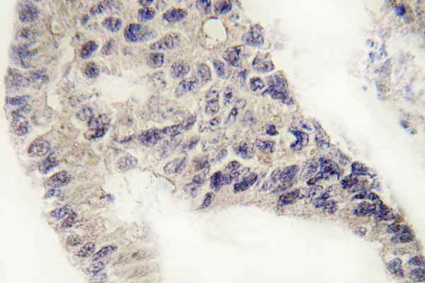 Recoverin Antibody - IHC of Recoverin (D143) pAb in paraffin-embedded human lung carcinoma tissue.