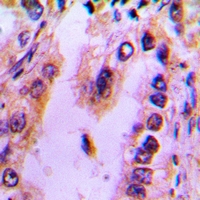 Recoverin Antibody - Immunohistochemical analysis of Recoverin staining in human lung cancer formalin fixed paraffin embedded tissue section. The section was pre-treated using heat mediated antigen retrieval with sodium citrate buffer (pH 6.0). The section was then incubated with the antibody at room temperature and detected with HRP and DAB as chromogen. The section was then counterstained with hematoxylin and mounted with DPX.