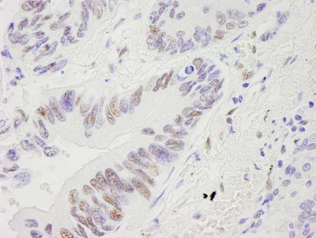 RECQ1 / RECQL Antibody - Detection of Human RecQ1 by Immunohistochemistry. Sample: FFPE section of human lung adenocarcinoma. Antibody: Affinity purified rabbit anti-RecQ1 used at a dilution of 1:250.