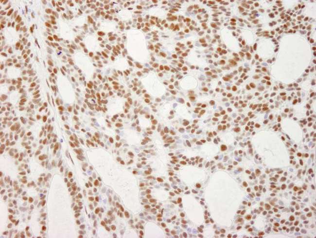 RECQ1 / RECQL Antibody - Detection of Human RecQ1 by Immunohistochemistry. Sample: FFPE section of human basal cell carcinoma. Antibody: Affinity purified rabbit anti-RecQ1 used at a dilution of 1:250.