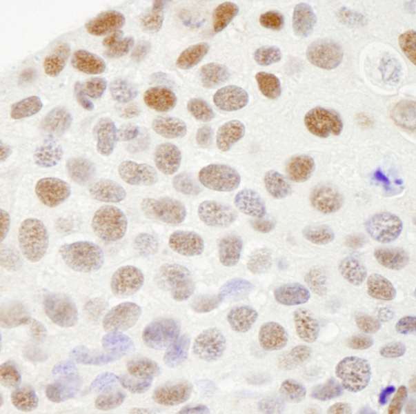 RECQ1 / RECQL Antibody - Detection of Human RecQ1 by Immunohistochemistry. Sample: FFPE section of human breast adenocarcinoma. Antibody: Affinity purified rabbit anti-RecQ1 used at a dilution of 1:250.
