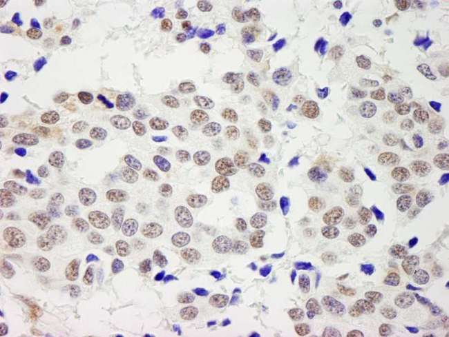 RECQ1 / RECQL Antibody - Detection of Human RecQ1 by Immunohistochemistry. Sample: FFPE section of human breast carcinoma. Antibody: Affinity purified rabbit anti-RecQ1 used at a dilution of 1:5000 (0.2 ug/ml). Detection: DAB.