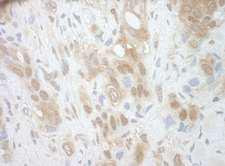 RECQ5 / RECQL5 Antibody - Detection of Human RECQ5 by Immunohistochemistry. Sample: FFPE section of human breast carcinoma. Antibody: Affinity purified rabbit anti-RECQ5 used at a dilution of 1:250.