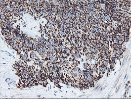 REEP2 Antibody - IHC of paraffin-embedded Adenocarcinoma of Human breast tissue using anti-REEP2 mouse monoclonal antibody.