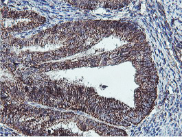 REEP2 Antibody - IHC of paraffin-embedded Adenocarcinoma of Human endometrium tissue using anti-REEP2 mouse monoclonal antibody.