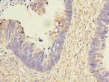 REEP2 Antibody - Immunohistochemistry of paraffin-embedded human ovarian cancer using antibody at dilution of 1:100.