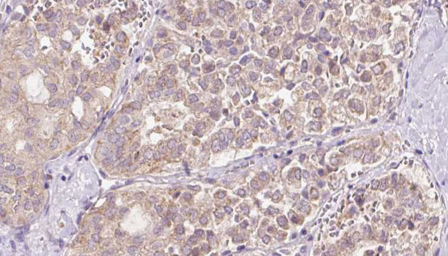 REEP2 Antibody - 1:100 staining human thyroid carcinoma tissue by IHC-P. The sample was formaldehyde fixed and a heat mediated antigen retrieval step in citrate buffer was performed. The sample was then blocked and incubated with the antibody for 1.5 hours at 22°C. An HRP conjugated goat anti-rabbit antibody was used as the secondary.