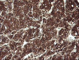 REEP5 Antibody - IHC of paraffin-embedded Carcinoma of Human liver tissue using anti-REEP5 mouse monoclonal antibody.