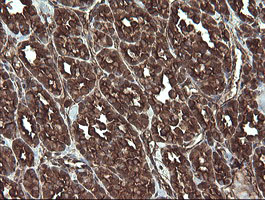 REEP5 Antibody - IHC of paraffin-embedded Carcinoma of Human thyroid tissue using anti-REEP5 mouse monoclonal antibody.