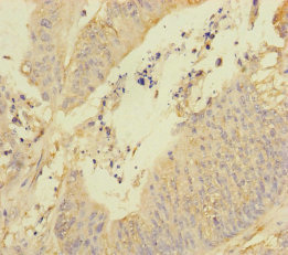 REEP5 Antibody - Immunohistochemistry of paraffin-embedded human colon cancer at dilution of 1:100