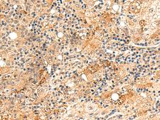 REG1B Antibody - Immunohistochemistry of paraffin-embedded Human liver cancer tissue  using REG1B Polyclonal Antibody at dilution of 1:60(×200)