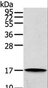 REG3A Antibody - Western blot analysis of Human cecum carcinoma tissue, using REG3A Polyclonal Antibody at dilution of 1:200.