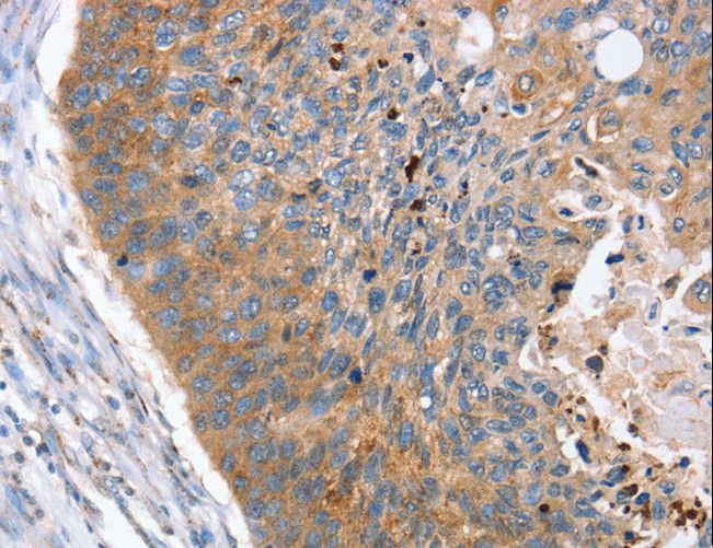 REG3A Antibody - Immunohistochemistry of paraffin-embedded Human esophagus cancer using REG3A Polyclonal Antibody at dilution of 1:40.