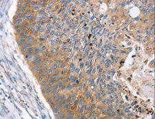 REG3A Antibody - Immunohistochemistry of paraffin-embedded Human esophagus cancer using REG3A Polyclonal Antibody at dilution of 1:40.