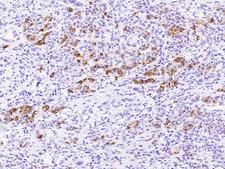 REG3A Antibody - Immunochemical staining of human REG3A in human pancreatic carcinoma with rabbit polyclonal antibody at 1:10000 dilution, formalin-fixed paraffin embedded sections.