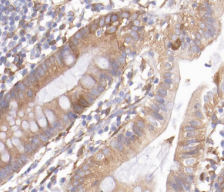 REG3G Antibody - 1:200 staining human colon carcinoma tissue by IHC-P. The tissue was formaldehyde fixed and a heat mediated antigen retrieval step in citrate buffer was performed. The tissue was then blocked and incubated with the antibody for 1.5 hours at 22°C. An HRP conjugated goat anti-rabbit antibody was used as the secondary.