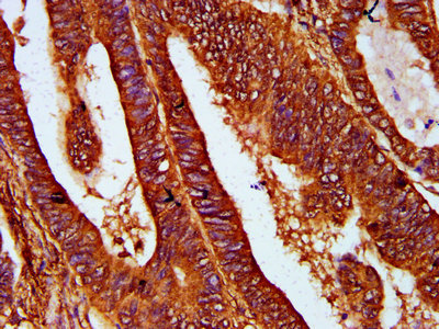 REG4 / REG-IV Antibody - Immunohistochemistry Dilution at 1:400 and staining in paraffin-embedded human colon cancer performed on a Leica BondTM system. After dewaxing and hydration, antigen retrieval was mediated by high pressure in a citrate buffer (pH 6.0). Section was blocked with 10% normal Goat serum 30min at RT. Then primary antibody (1% BSA) was incubated at 4°C overnight. The primary is detected by a biotinylated Secondary antibody and visualized using an HRP conjugated SP system.