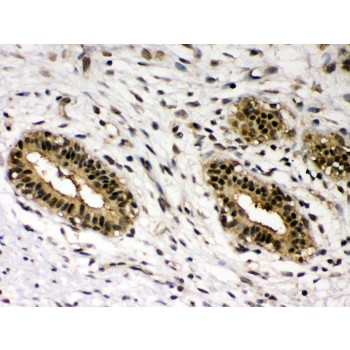 REL / C-Rel Antibody - c-Rel antibody IHC-paraffin. IHC(P): Human Mammary Cancer Tissue.