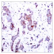 REL / C-Rel Antibody - Immunohistochemistry analysis of paraffin-embedded human breast carcinoma tissue, using Rel Antibody. The picture on the right is blocked with the synthesized peptide.