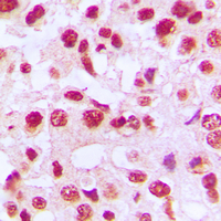 REL / C-Rel Antibody - Immunohistochemical analysis of c-Rel staining in human breast cancer formalin fixed paraffin embedded tissue section. The section was pre-treated using heat mediated antigen retrieval with sodium citrate buffer (pH 6.0). The section was then incubated with the antibody at room temperature and detected using an HRP conjugated compact polymer system. DAB was used as the chromogen. The section was then counterstained with hematoxylin and mounted with DPX.