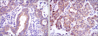 REL / C-Rel Antibody - IHC of paraffin-embedded endometrial cancer tissues (left) and liver cancer tissues (right) using c-Rel mouse monoclonal antibody with DAB staining.