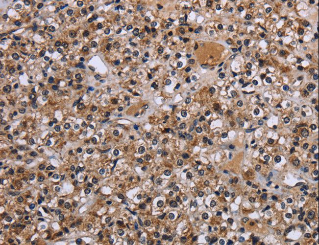 REL / C-Rel Antibody - Immunohistochemistry of paraffin-embedded Human prostate cancer using REL Polyclonal Antibody at dilution of 1:30.