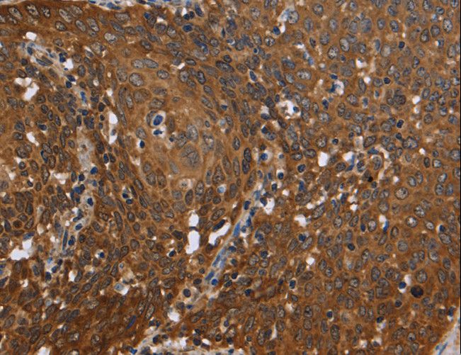 REL / C-Rel Antibody - Immunohistochemistry of paraffin-embedded Human cervical cancer using REL Polyclonal Antibody at dilution of 1:50.
