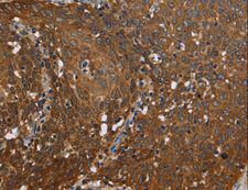 REL / C-Rel Antibody - Immunohistochemistry of paraffin-embedded Human cervical cancer using REL Polyclonal Antibody at dilution of 1:50.