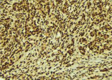 REL / C-Rel Antibody - 1:100 staining human breast carcinoma tissue by IHC-P. The sample was formaldehyde fixed and a heat mediated antigen retrieval step in citrate buffer was performed. The sample was then blocked and incubated with the antibody for 1.5 hours at 22°C. An HRP conjugated goat anti-rabbit antibody was used as the secondary.