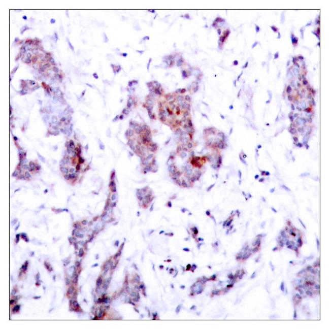 REL / C-Rel Antibody - Immunohistochemical analysis of paraffin-embedded breast carcinoma, using c-Rel (Ab-503) Antibody.