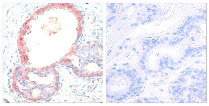 REL / C-Rel Antibody - Immunohistochemistry analysis of paraffin-embedded human breast carcinoma, using Rel (Phospho-Ser503) Antibody. The picture on the right is blocked with the phospho peptide.