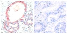 REL / C-Rel Antibody - Immunohistochemical analysis of paraffin-embedded breast carcinoma, Left: Using c-Rel (Phospho- Ser503) Antibody; Right: The same antibody preincubated with synthesized phosphopeptide.