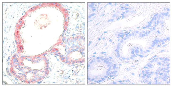 REL / C-Rel Antibody - Immunohistochemical analysis of paraffin-embedded breast carcinoma, Left: Using c-Rel (Phospho- Ser503) Antibody; Right: The same antibody preincubated with synthesized phosphopeptide.