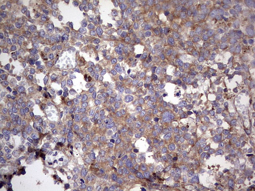RELA / NFKB p65 Antibody - IHC of paraffin-embedded Human melanoma tissue using Rabbit polyclonal anti-RELA antibody at (Heat-induced epitope retrieval by 1 mM EDTA in 10mM Tris, pH8.5, 120°C for 3min).