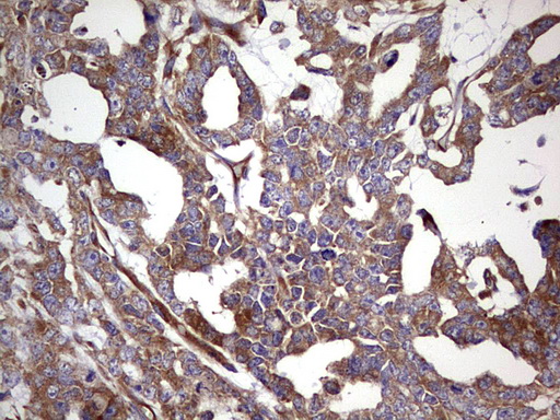 RELA / NFKB p65 Antibody - IHC of paraffin-embedded Human testicular cancer tissue using Rabbit polyclonal anti-RELA antibody at (Heat-induced epitope retrieval by 1 mM EDTA in 10mM Tris, pH8.5, 120°C for 3min).