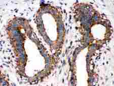 RELA / NFKB p65 Antibody - Anti-NF-kB p65 antibody, IHC(P): Human Mammary Cancer Tissue