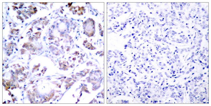 RELA / NFKB p65 Antibody - Immunohistochemistry analysis of paraffin-embedded human breast carcinoma tissue, using NF-kappaB p65 Antibody. The picture on the right is blocked with the synthesized peptide.