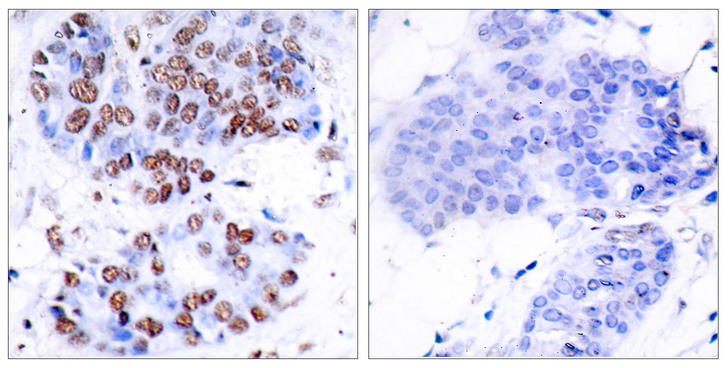 RELA / NFKB p65 Antibody - Immunohistochemistry analysis of paraffin-embedded human breast carcinoma tissue, using NF-kappaB p65 Antibody. The picture on the right is blocked with the synthesized peptide.