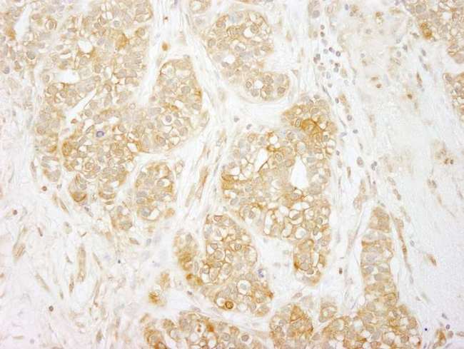 RELA / NFKB p65 Antibody - Detection of Human RelA Immunohistochemistry. Sample: FFPE section of human breast carcinoma. Antibody: Affinity purified rabbit anti-RelA used at a dilution of 1:250.